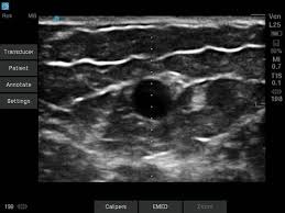 Vascular Access Ultrasound
